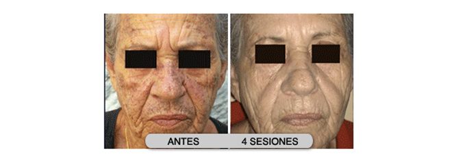 Luz Pulsada Intensa facial - Dr. Alejandro Silvestre