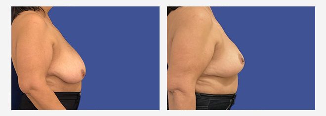 reduccion-mamaria-perfil